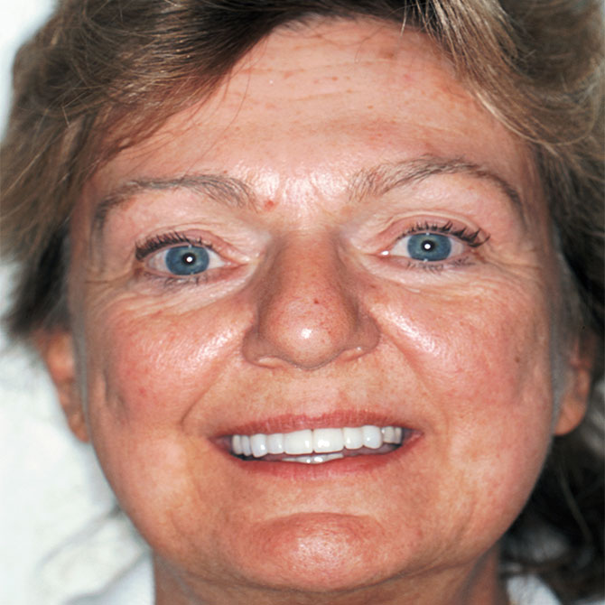 1-Full-smile-veneers----After