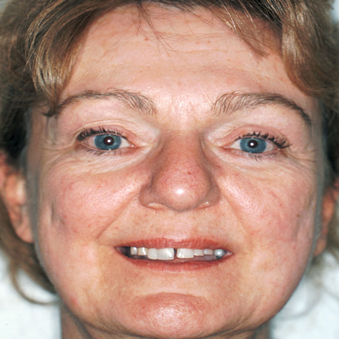 1-Full-smile-veneers---Before