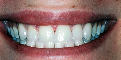 10-Full-smile-veneers---After