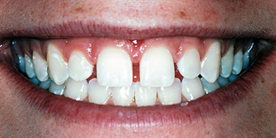 10-Full-smile-veneers---Before