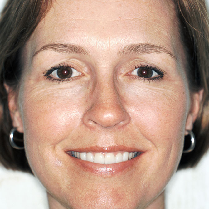 11-6-upper-veneers---After