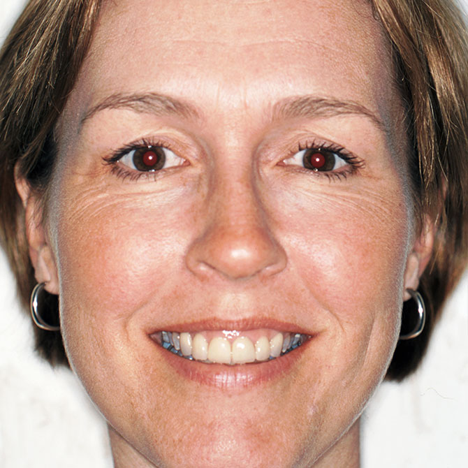 11-6-upper-veneers---Before
