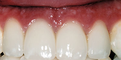 21-Veneers---After