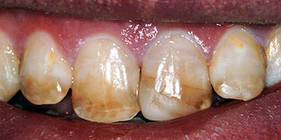 21-Veneers---Before