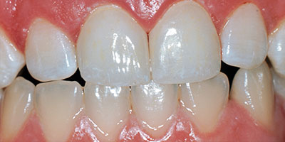 24-Porcelain-veneers-on-two-front-broken-teeth---After