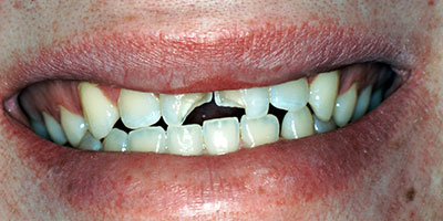 24-Porcelain-veneers-on-two-front-broken-teeth---Before