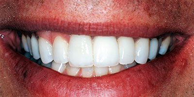 25-Veneers-front-6-teeth---After