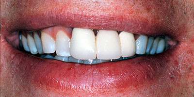25-Veneers-front-6-teeth---Before