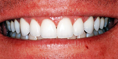 26-Veneers-front-6-teeth---After