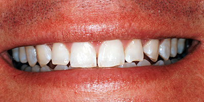 26-Veneers-front-6-teeth---Before