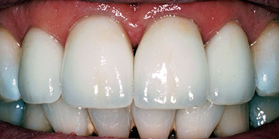 27-Porcelain-crowns-on-the-front-two-teeth-and-veneers-on-the-lateral-incisors---After