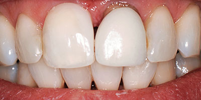 27-Porcelain-crowns-on-the-front-two-teeth-and-veneers-on-the-lateral-incisors---Before
