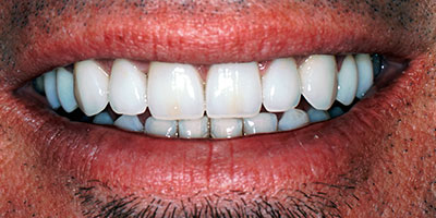 28-Full-smile-of-crowns-and-veneers---After
