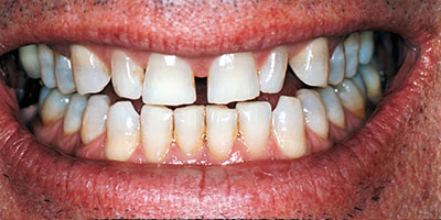 28-Full-smile-of-crowns-and-veneers---Before