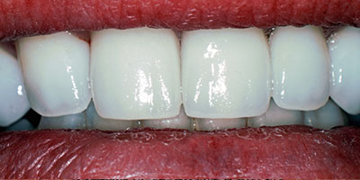 29-Veneers---After