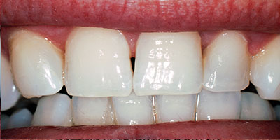 29-Veneers---Before