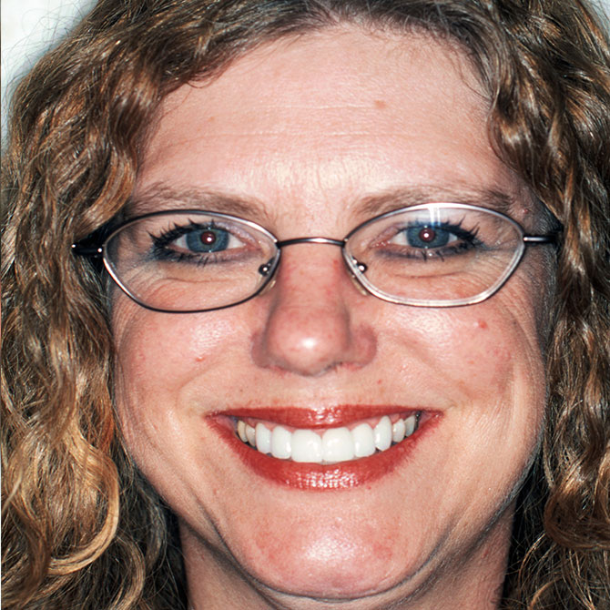 3-Full-smile-veneers---After