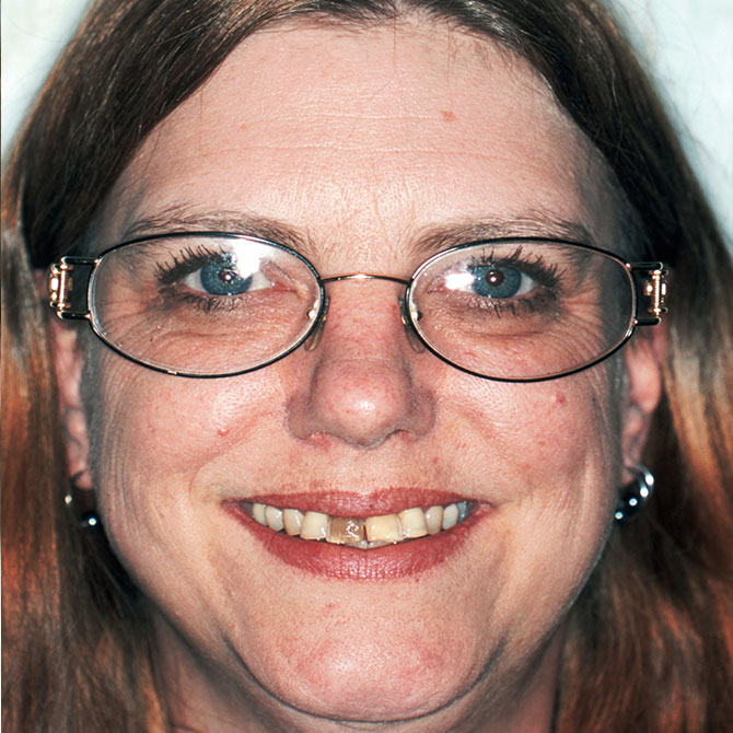3-Full-smile-veneers---Before-