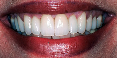 30-Veneers-and-crowns-on-front-10-teeth---After
