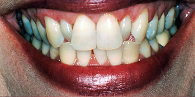 30-Veneers-and-crowns-on-front-10-teeth---Before-