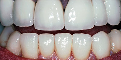 32-lower-veneers-on-the-front-6-teeth---After