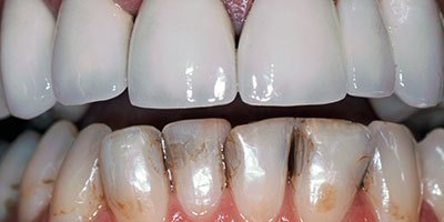 32-lower-veneers-on-the-front-6-teeth---Before-