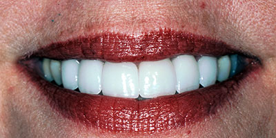 4-full-smile-veneers---After