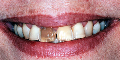 4-full-smile-veneers---Before