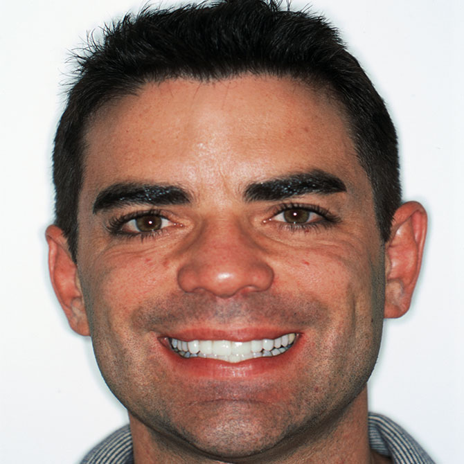 5-veneers-front-upper-6-teeth---After
