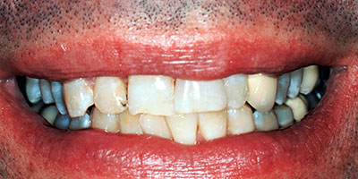 6-veneers-front-upper-6-teeth---Before