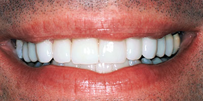 6-veneers-front-upper-6-teeth