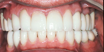 8-Full-mouth-reconstruction-with-crowns---After