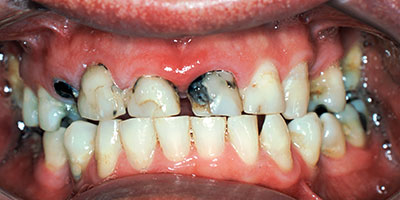 8-Full-mouth-reconstruction-with-crowns---Before