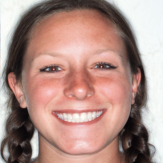9-Full-smile-veneers---After