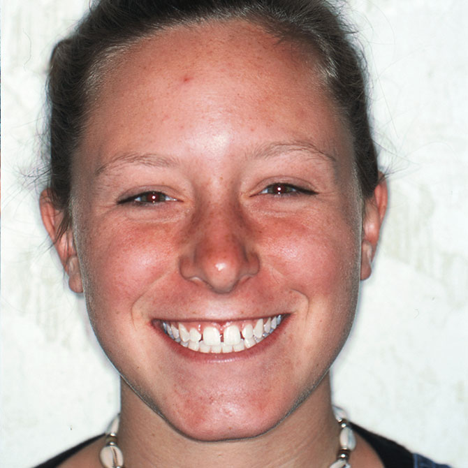 9-Full-smile-veneers---Before