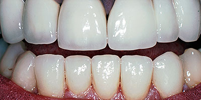 case-1-after-400x200