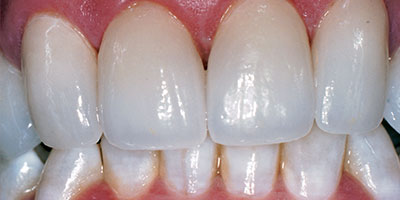 case-11-after-400x200