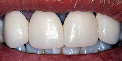 case-11-before-400x200