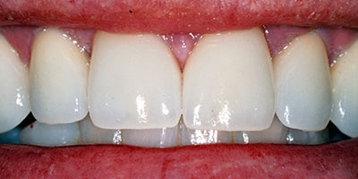 case-12-after-400x200