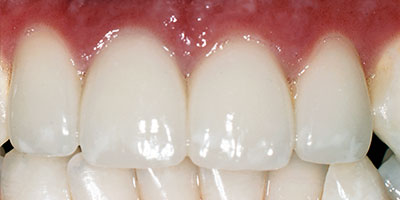 case-13-after-400x200