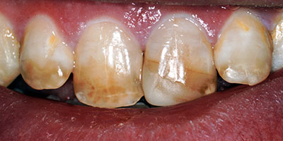 case-13-before-400x200