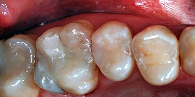 case-16-after-400x200