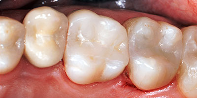 case-17-after-400x200