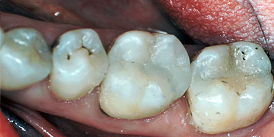 case-18-after-400x200