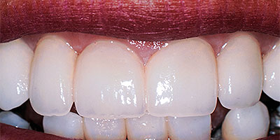 case-2-after-400x200