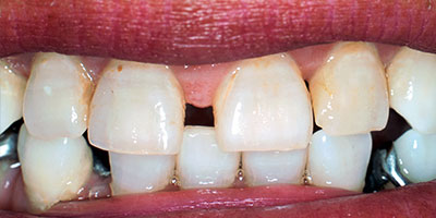 case-2-before-400x200