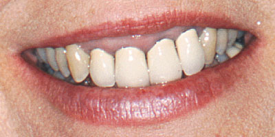case-20-before-400x200