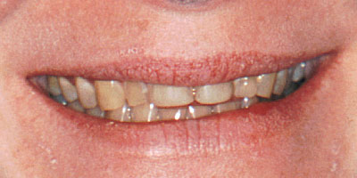 case-21-before-400x200