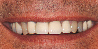case-22-before-400x200