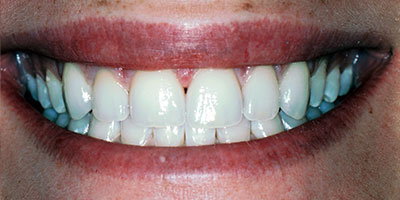case-25-after-400x200